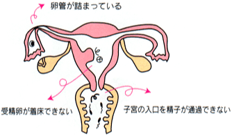 不妊の原因