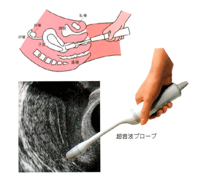 超音波検査